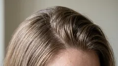 Håret blir snabbt fett: Varför händer det och vad kan man göra?
